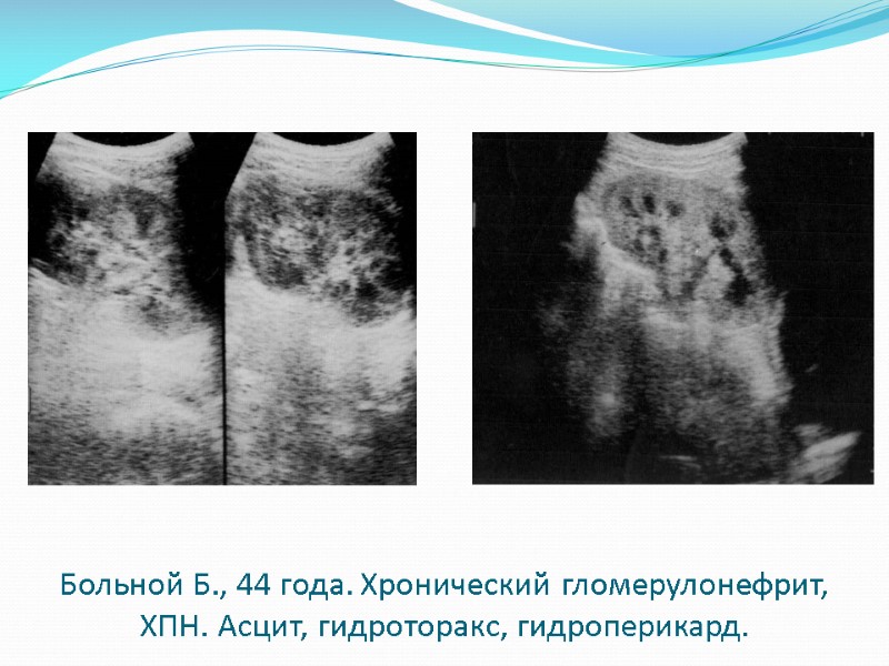Больной Б., 44 года. Хронический гломерулонефрит, ХПН. Асцит, гидроторакс, гидроперикард.